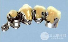 钛合金烤瓷牙套怎么样了，价格贵不贵了?