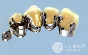 钛合金烤瓷牙套怎么样了，价格贵不贵了?