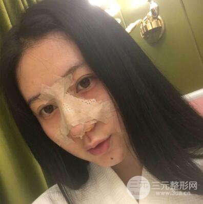 合肥壹加壹王大勇假体隆鼻果对比图 45天恢复心路历程