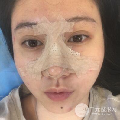 合肥壹加壹王大勇假体隆鼻果对比图 45天恢复心路历程