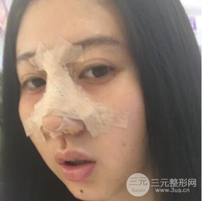 合肥壹加壹王大勇假体隆鼻果对比图 45天恢复心路历程