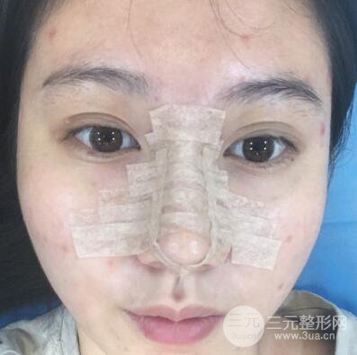 合肥壹加壹王大勇假体隆鼻果对比图 45天恢复心路历程