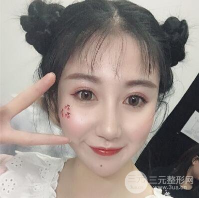 合肥壹加壹王大勇假体隆鼻果对比图 45天恢复心路历程