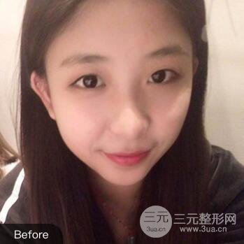 沈阳军区总医院时杰切开双眼皮案例对比图|内附心情恢复小札哦