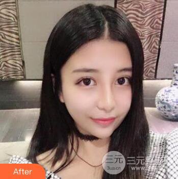 沈阳军区总医院时杰切开双眼皮案例对比图|内附心情恢复小札哦