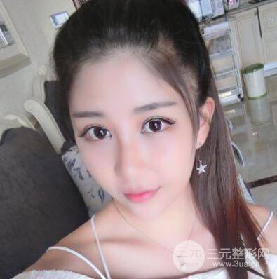 沈阳军区总医院时杰切开双眼皮案例对比图|内附心情恢复小札哦