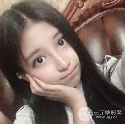 沈阳军区总医院时杰切开双眼皮案例对比图|内附心情恢复小札哦