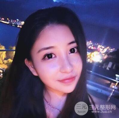 沈阳军区总医院时杰切开双眼皮案例对比图|内附心情恢复小札哦