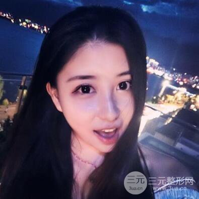 沈阳军区总医院时杰切开双眼皮案例对比图|内附心情恢复小札哦