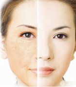 彩光嫩肤会反弹吗，果怎么样了