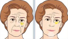 吸脂去下眼睑眼袋需要多少钱了，果好不好了?