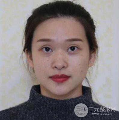 哈尔滨哈美莱郑东学隆鼻整形案例对比图真实心情分享哟~