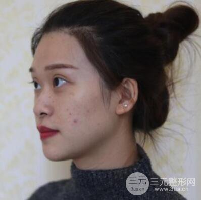 哈尔滨哈美莱郑东学隆鼻整形案例对比图真实心情分享哟~