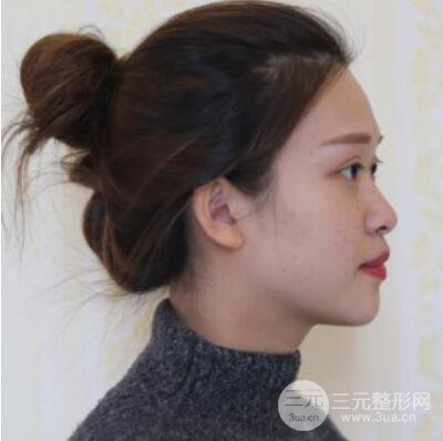哈尔滨哈美莱郑东学隆鼻整形案例对比图真实心情分享哟~