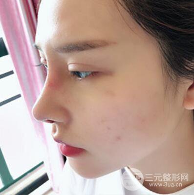 哈尔滨哈美莱郑东学隆鼻整形案例对比图真实心情分享哟~