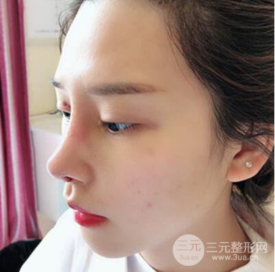 哈尔滨哈美莱郑东学隆鼻整形案例对比图真实心情分享哟~