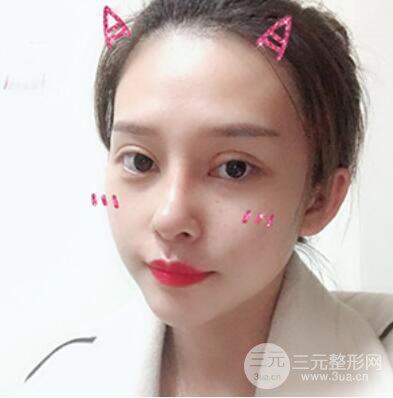 哈尔滨哈美莱郑东学隆鼻整形案例对比图真实心情分享哟~