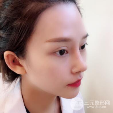 哈尔滨哈美莱郑东学隆鼻整形案例对比图真实心情分享哟~