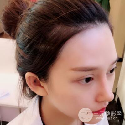 哈尔滨哈美莱郑东学隆鼻整形案例对比图真实心情分享哟~