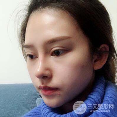 哈尔滨哈美莱郑东学隆鼻整形案例对比图真实心情分享哟~