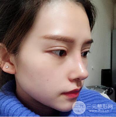 哈尔滨哈美莱郑东学隆鼻整形案例对比图真实心情分享哟~