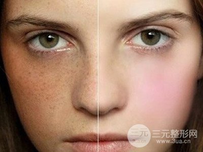 去黄褐斑的价格 光子嫩肤可以去黄褐斑吗