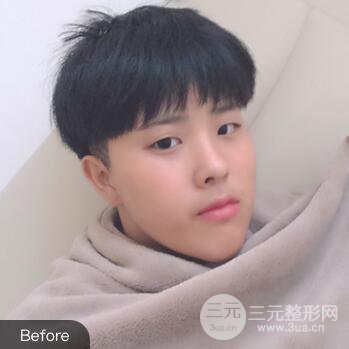 哈医大二院整形科肖志波割双眼皮对比图男性案例