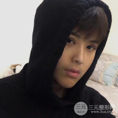 哈医大二院整形科肖志波割双眼皮对比图男性案例