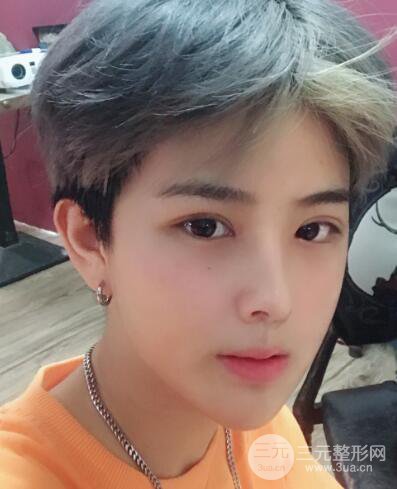 哈医大二院整形科肖志波割双眼皮对比图男性案例