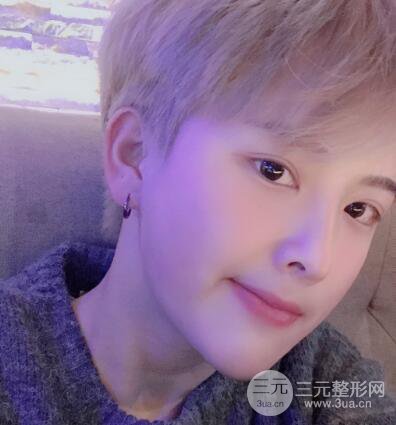 哈医大二院整形科肖志波割双眼皮对比图男性案例