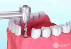 全新种植牙技术多少钱?影响其价格的主要因素有哪些?