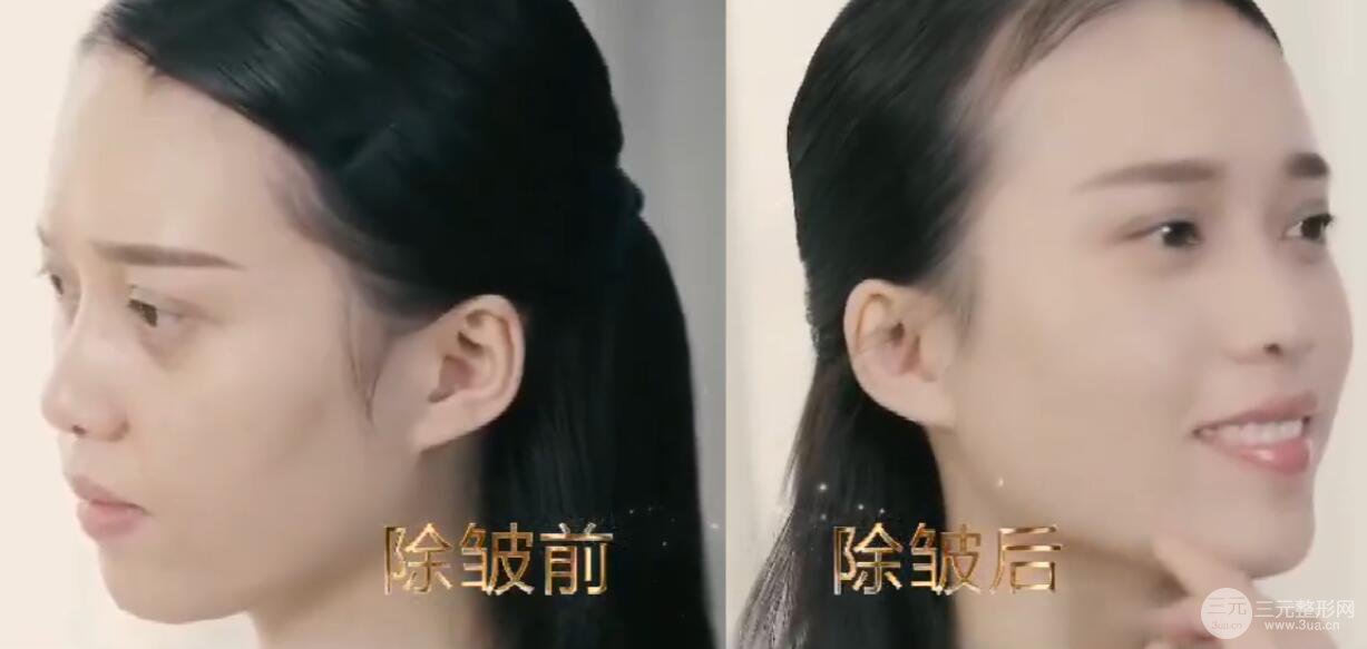 伊w兰除皱大概需要多少钱呢?