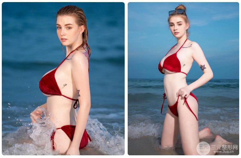 娜高假体丰胸果怎么样 娜高假体丰胸好吗