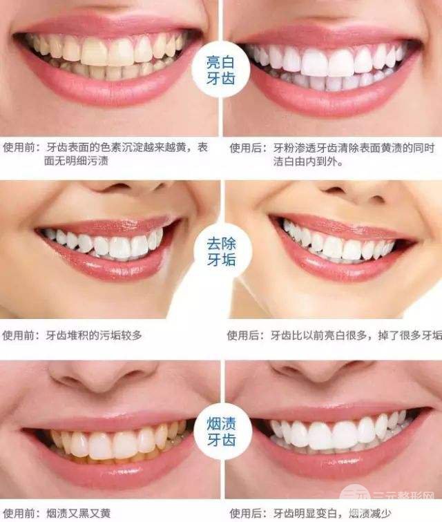 烤瓷牙的材料有哪些 烤瓷牙自然吗？