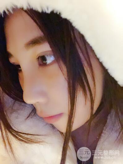 贵阳丽都李观龙隆鼻整形案例对照图一个月恢复过程分享