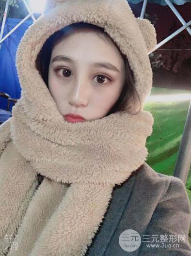 贵阳丽都李观龙隆鼻整形案例对照图一个月恢复过程分享