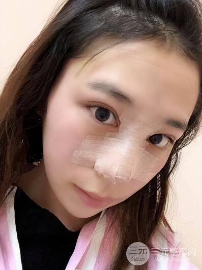 贵阳丽都李观龙隆鼻整形案例对照图一个月恢复过程分享