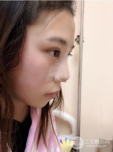 贵阳丽都李观龙隆鼻整形案例对照图一个月恢复过程分享