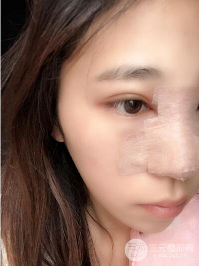 贵阳丽都李观龙隆鼻整形案例对照图一个月恢复过程分享