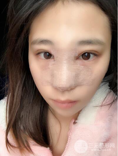 贵阳丽都李观龙隆鼻整形案例对照图一个月恢复过程分享