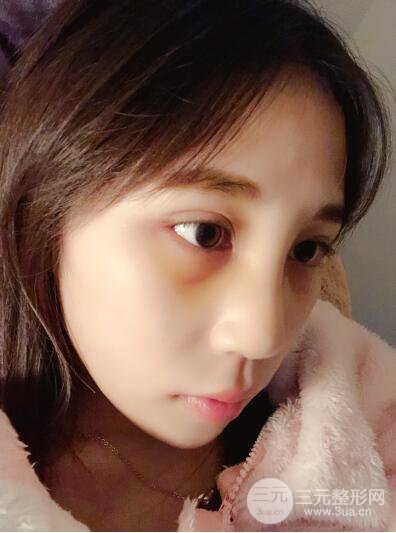 贵阳丽都李观龙隆鼻整形案例对照图一个月恢复过程分享