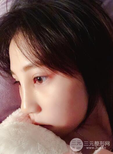 贵阳丽都李观龙隆鼻整形案例对照图一个月恢复过程分享