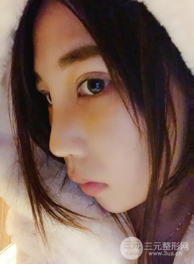 贵阳丽都李观龙隆鼻整形案例对照图一个月恢复过程分享