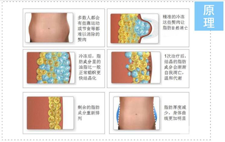 冰冻溶脂减肥的副作用有哪些?
