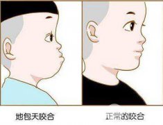 矫正地包天的比较好年龄 地包天怎么矫正