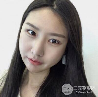 西安叶子鲁礼新埋线双眼皮案例对照图!两个月恢复心情小记