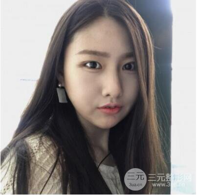 西安叶子鲁礼新埋线双眼皮案例对照图!两个月恢复心情小记