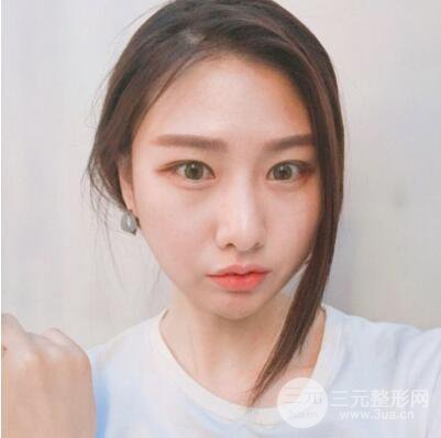 西安叶子鲁礼新埋线双眼皮案例对照图!两个月恢复心情小记