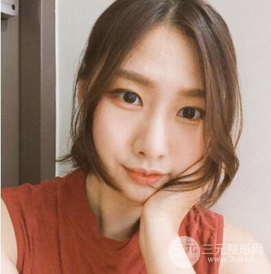 西安叶子鲁礼新埋线双眼皮案例对照图!两个月恢复心情小记