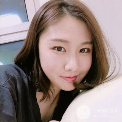 西安叶子鲁礼新埋线双眼皮案例对照图!两个月恢复心情小记